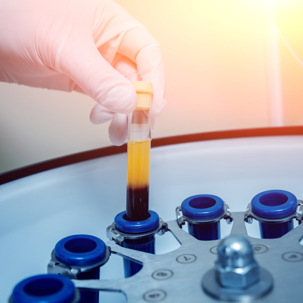 Platelet-rich plasma prepared from centrifuge